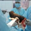 В Чечне врачи достали из желудка 11-летней «Рапунцель» три кг волос